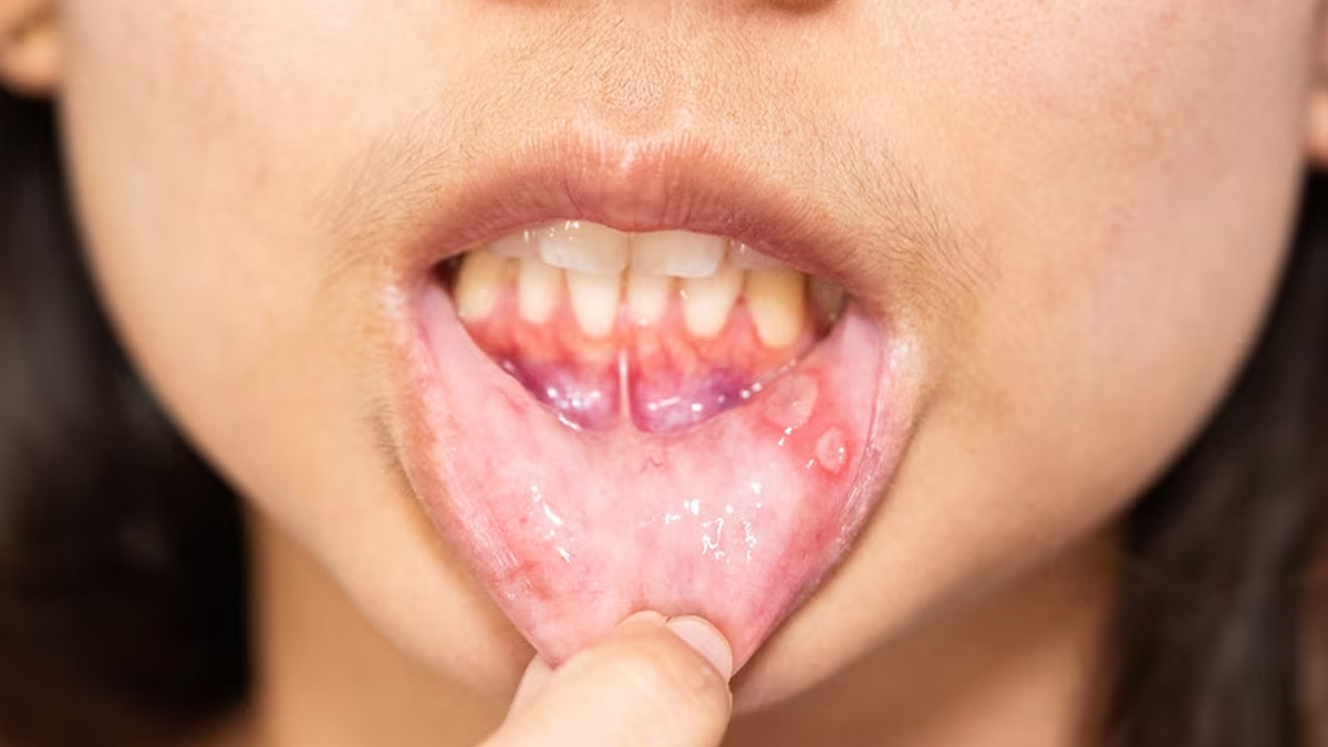 Do You Get Mouth Ulcers Frequently Herere The Possible Reasons OnlyMyHealth