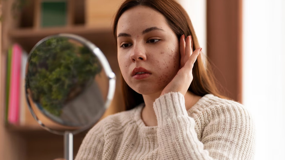 causes of pimples during monsoon in hindi