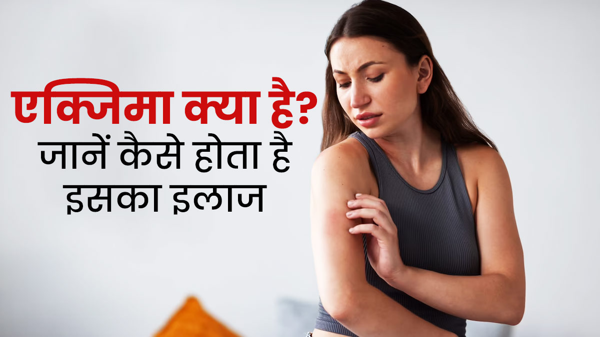एक्जिमा क्या होता है? आसान भाषा में समझें इसके लक्षण, कारण और इलाज