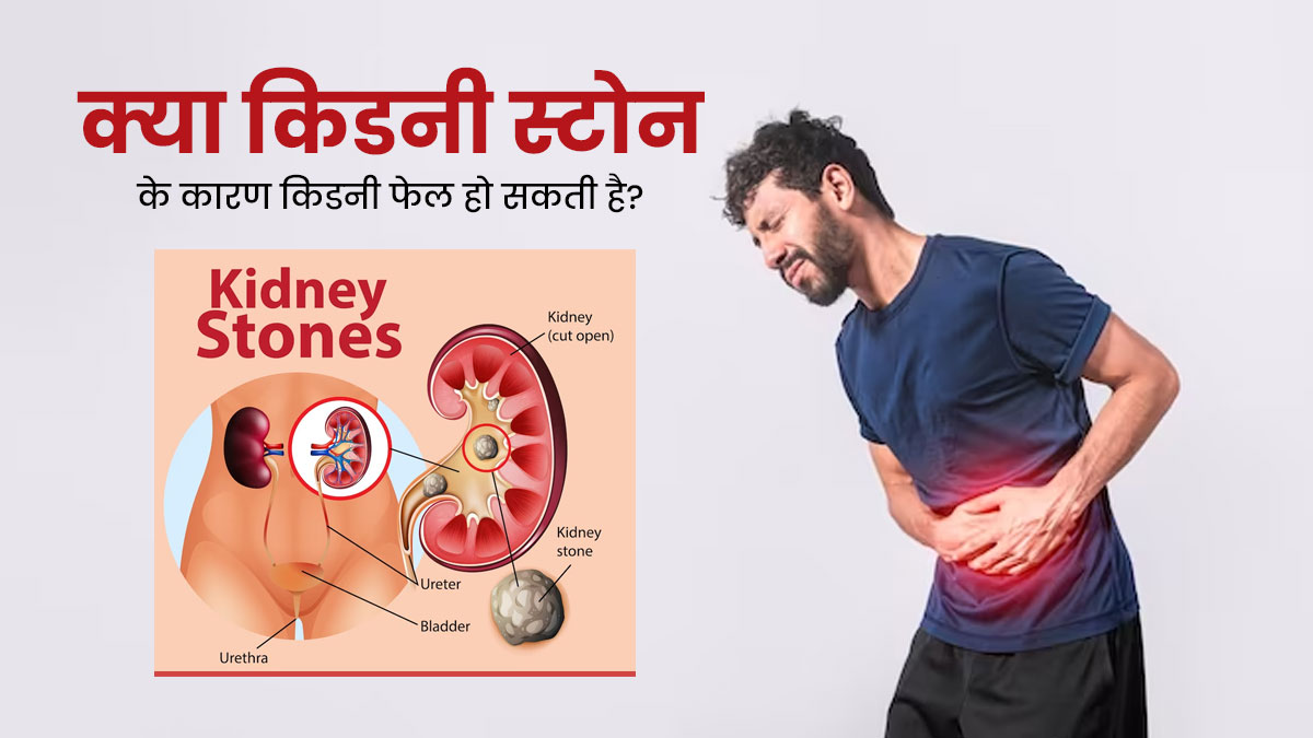 Can Kidney Stones Lead To Kidney Failure