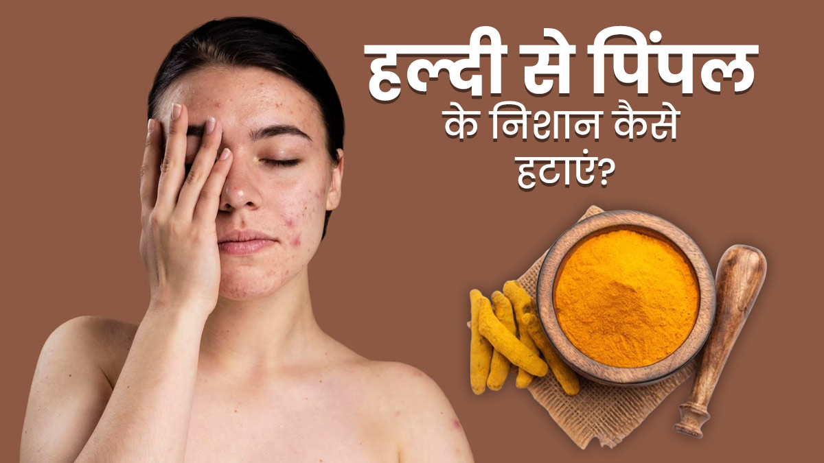 मुंहासों के निशान हटाने के लिए हल्दी का इन 4 तरीकों से करें इस्तेमाल, मिलेगी साफ और बेदाग त्वचा