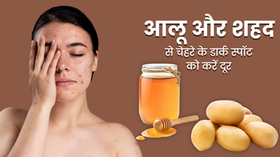 चेहरे के डार्क स्पॉट्स हटाने में मदद करेगा आलू और शहद का पेस्ट, जानें इस्तेमाल का तरीका 