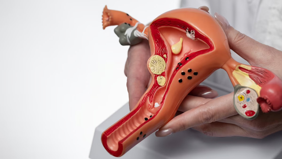 Endometriosis