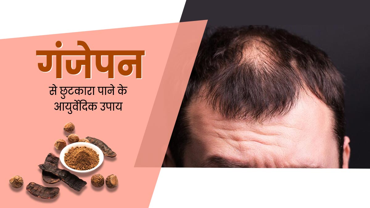 गंजेपन की समस्या से हैं परेशान? अपनाएं ये 5 आयुर्वेदिक उपाय, जिनसे दोबारा उगने लगेंगे बाल
