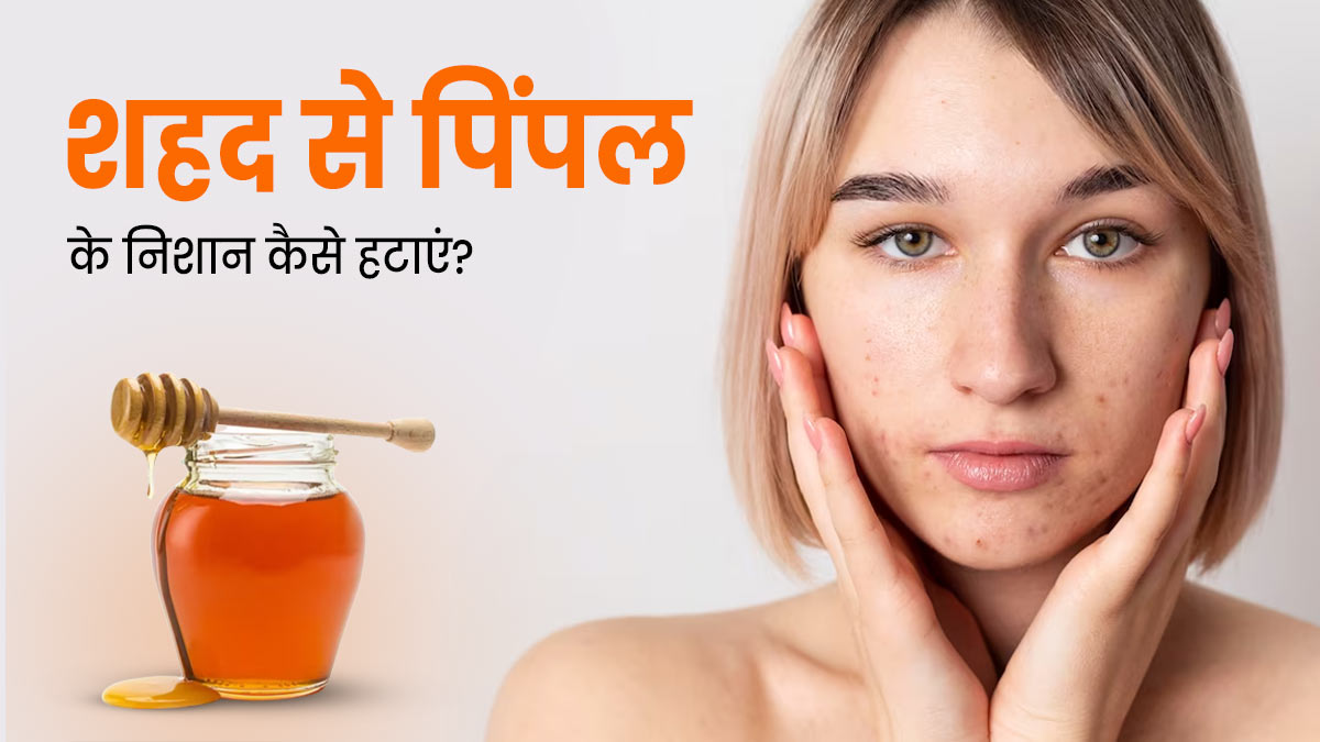 मुंहासों के दाग हटाने के लिए शहद का इन 4 तरीकों से करें इस्तेमाल, मिलेगी निखरी-बेदाग त्वचा