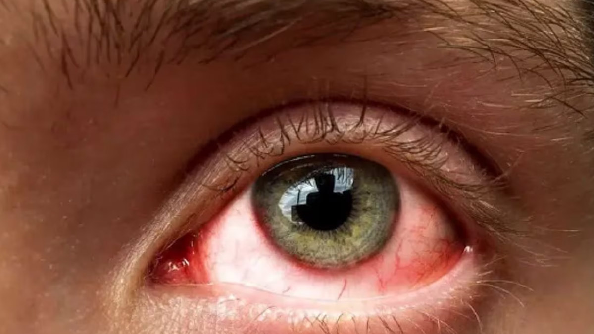 eye flu