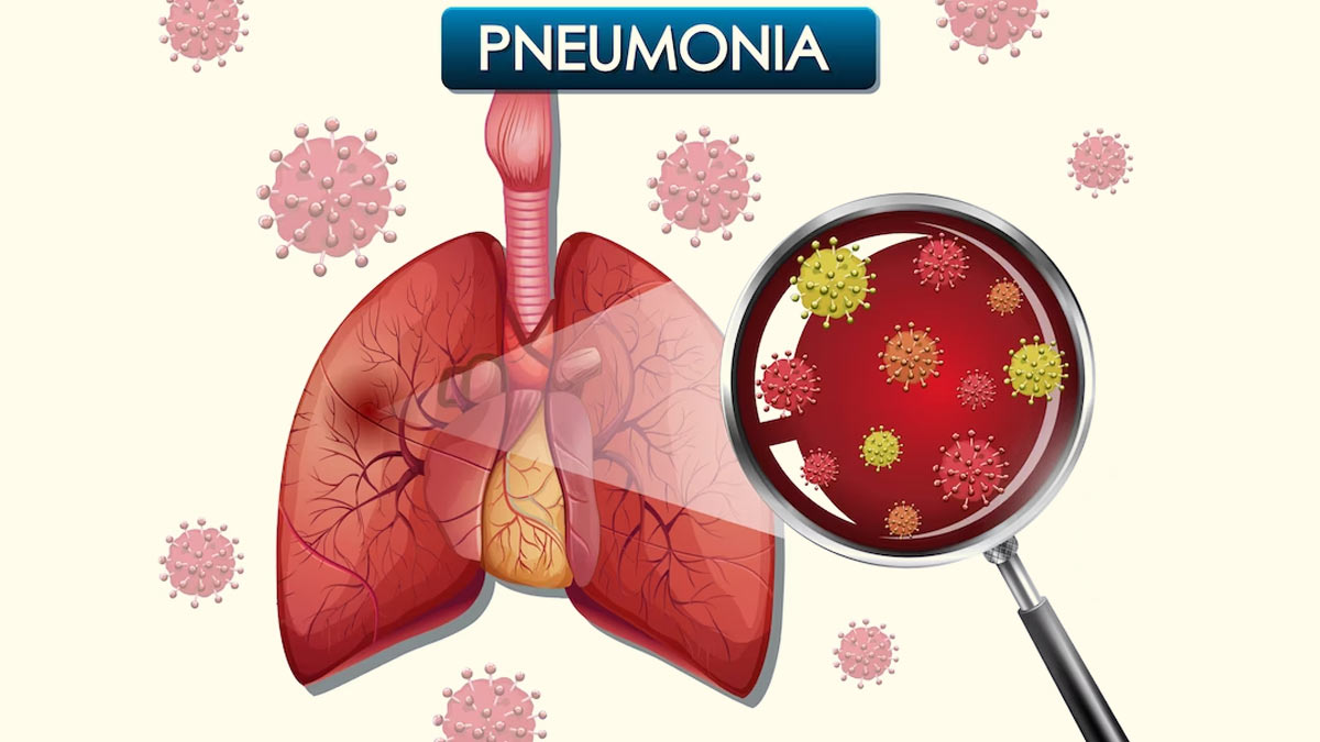 Main Pneumonia 