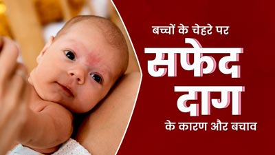 शिशु के चेहरे पर भी हो सकते हैं सफेद दाग, जानें इसके कारण और बचाव के उपाय