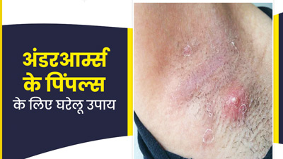 अंडरआर्म्स (कांख) में निकल आए हैं पिंपल्स, तो आजमाएं ये 5 घरेलू उपाय
