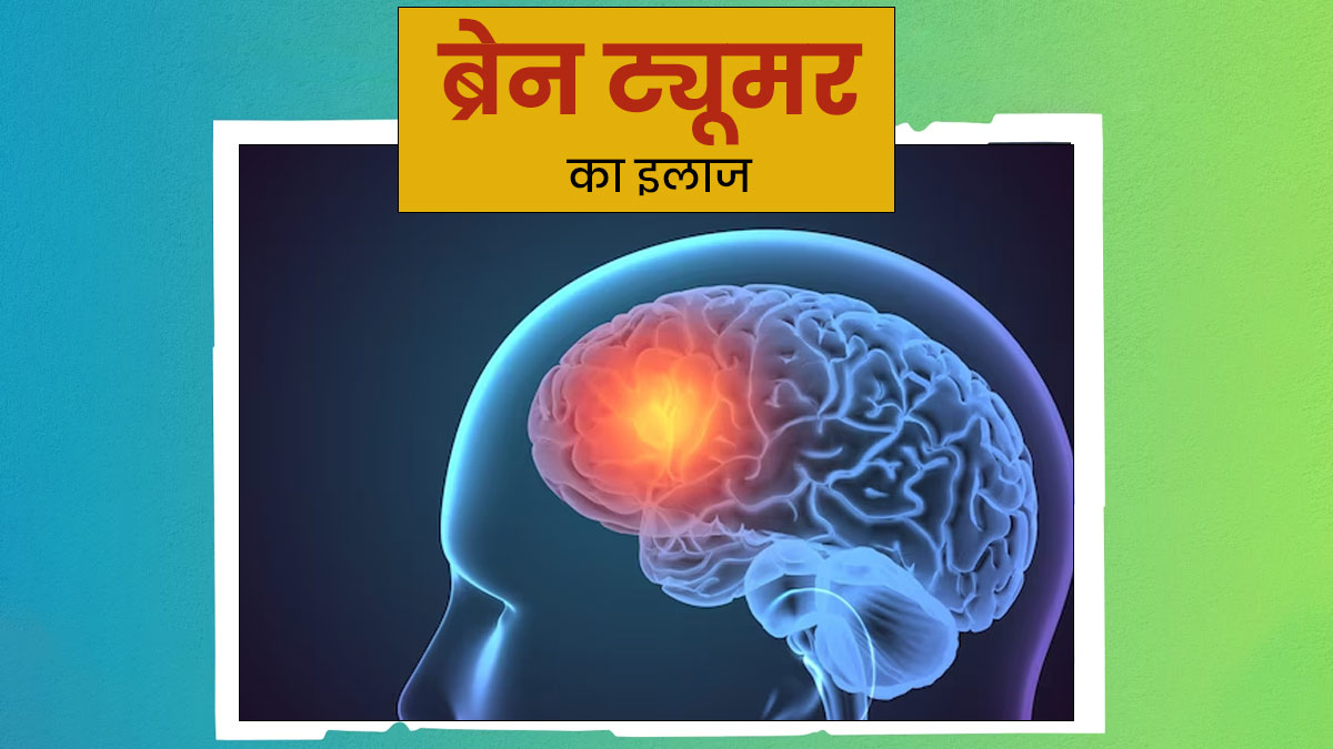 World Brain Tumor Day: ब्रेन ट्यूमर का इलाज कैसे क‍िया जाता है? डॉक्‍टर से जानें  