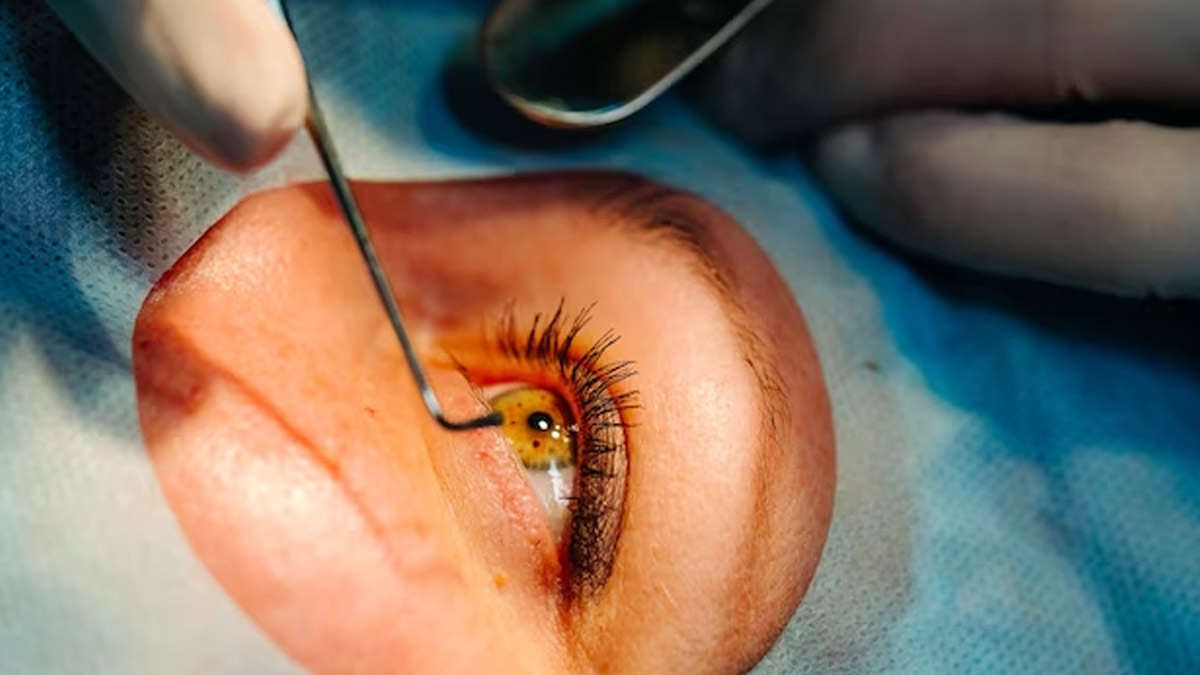 corneal-transplant