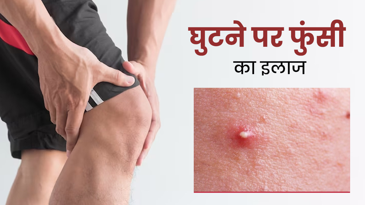 घुटने पर भी हो सकते हैं पिंपल्स, जानें इसके कारण और ठीक करने के 5 घरेलू उपाय