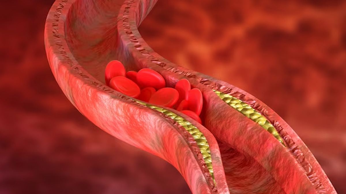 Can Ghee Raise Cholesterol