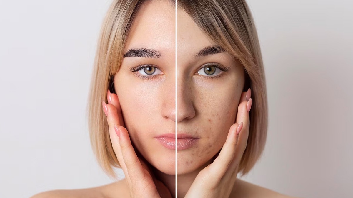 How To Use Olive Oil To Remove Pimple