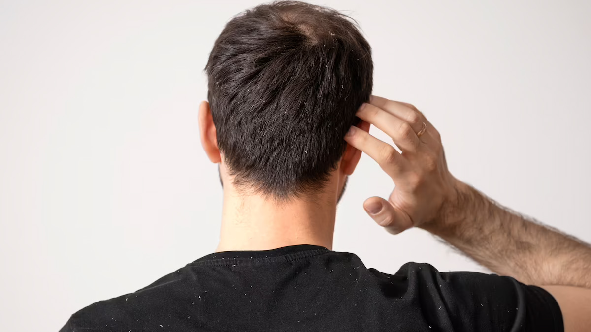 onion and ginger hair mask for dandruff