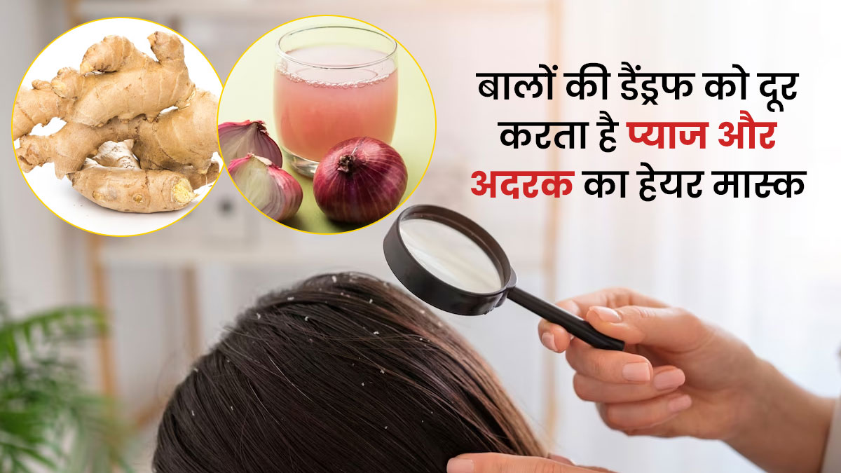 बालों पर लगाएं प्याज और अदरक से बना यह हेयर मास्क, दूर होगी डैंड्रफ की समस्या