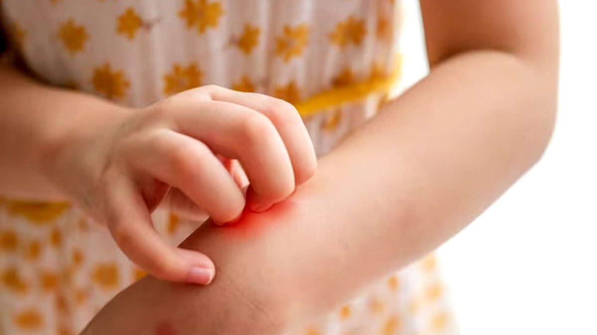 Rashes After Fever In Toddlers in Hindi