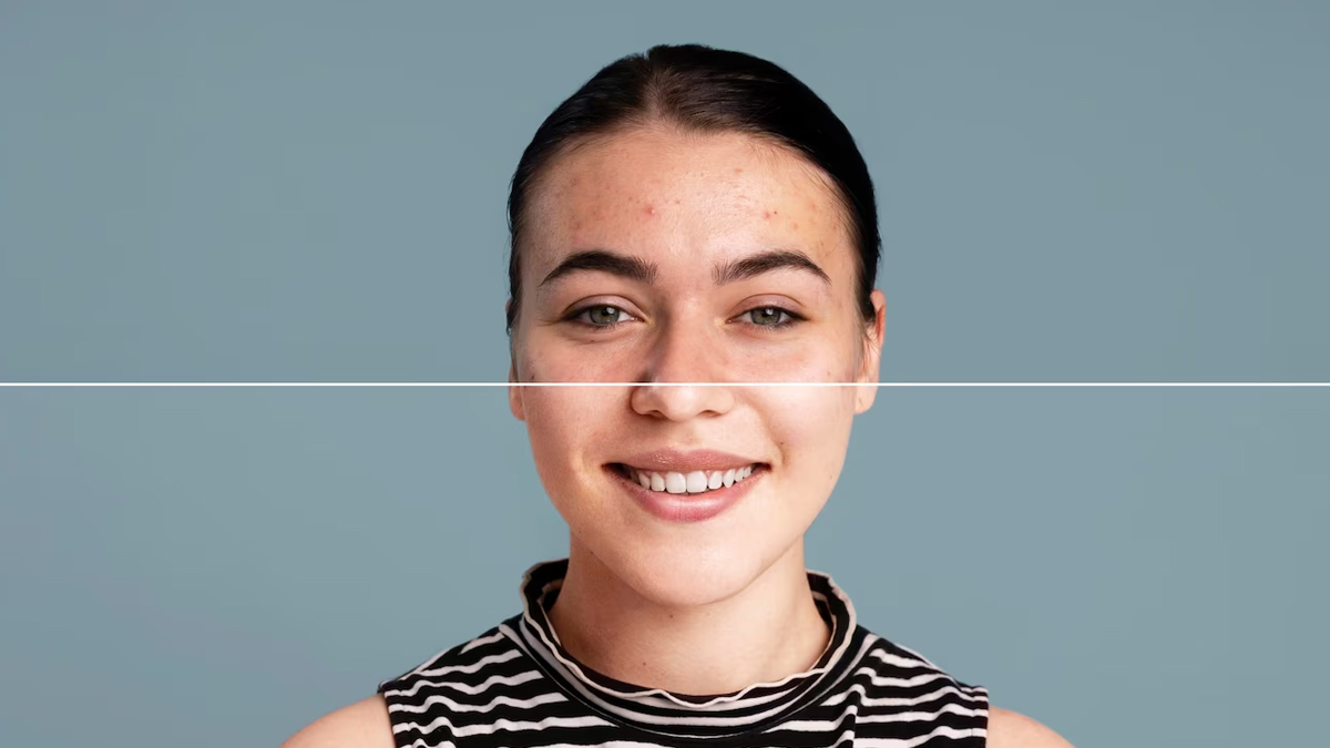 Tea Tree Oil For Scars: