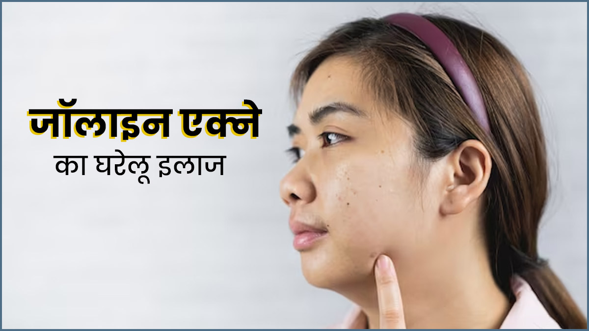 पीर‍ियड्स में ठोड़ी और जॉलाइन पर हो जाते हैं प‍िंंपल्‍स? इन 5 घरेलू उपाय से करें इलाज 