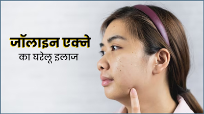 पीर‍ियड्स में ठोड़ी और जॉलाइन पर हो जाते हैं प‍िंंपल्‍स? इन 5 घरेलू उपाय से करें इलाज 