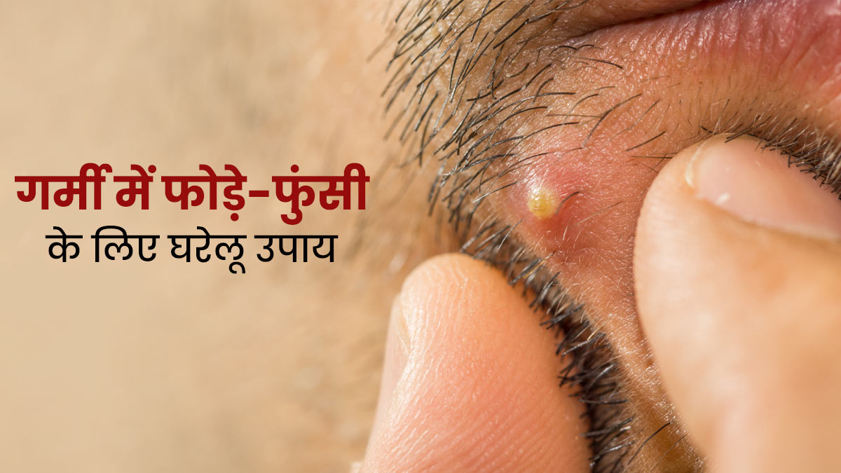 गर्मी में हो जाते हैं फोड़े-फुंसियों से परेशान, तो आजमाएं ये 5 घरेलू उपाय 