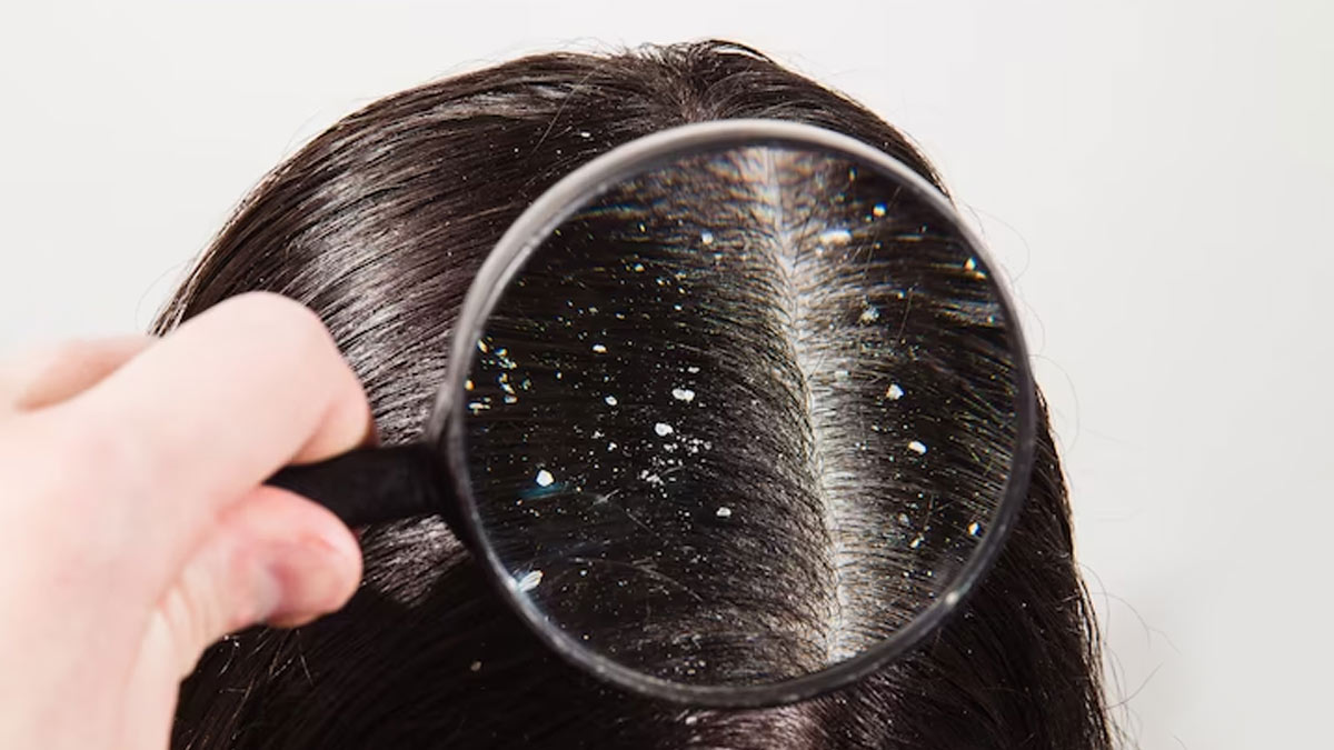 hair fall in summer