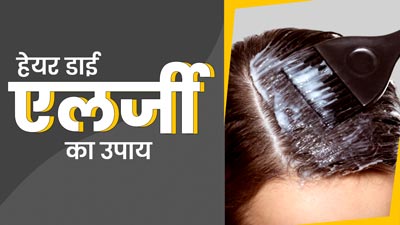 हेयर डाई लगाने से हो गई है एलर्जी? डॉक्‍टर से जानें इसका इलाज 