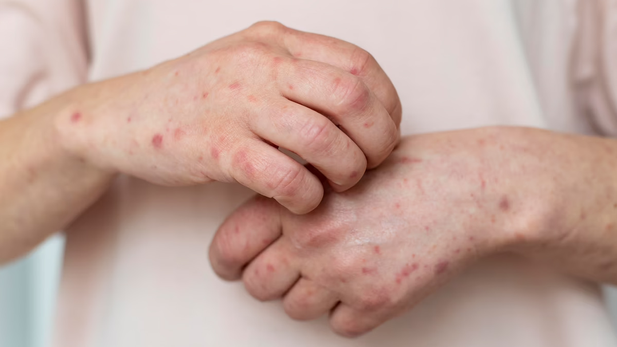 treatment of chicken pox