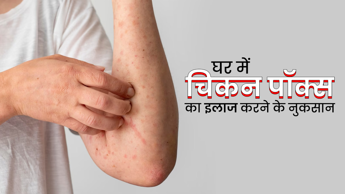  चिकनपॉक्स होने पर घर में ही करने लगते हैं इलाज? तो डॉक्टर से जानें इसके नुकसान