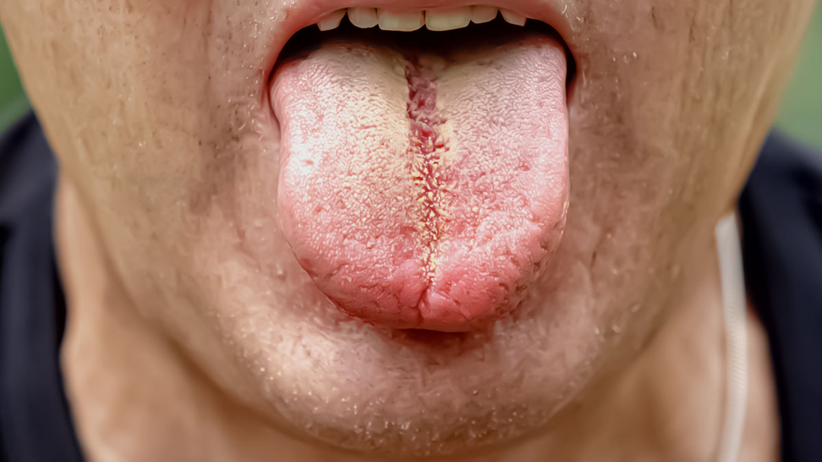 white-patches-in-your-mouth-expert-explains-leukoplakia-and-what-it