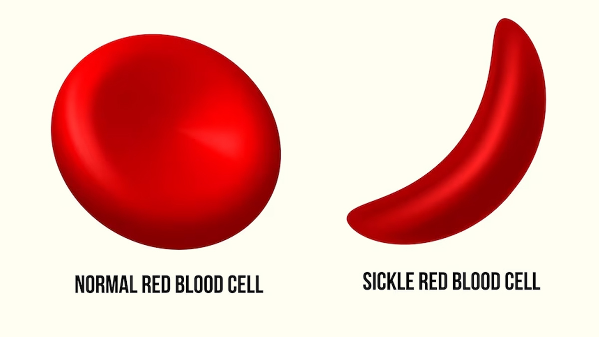 خلايا الدم الحمراء المنجلية