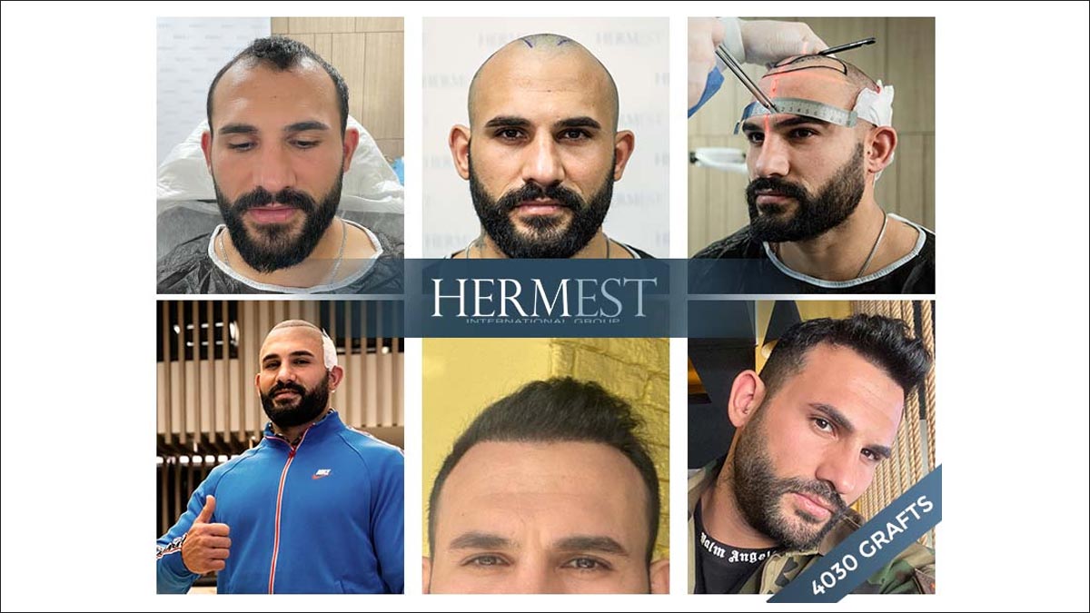 أفضل عيادات زراعة الشعر في تركيا