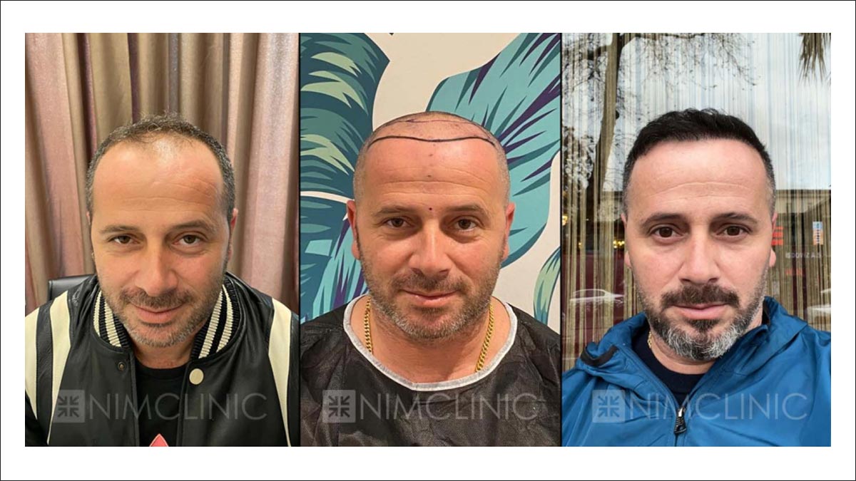 عيادات زراعة الشعر في تركيا