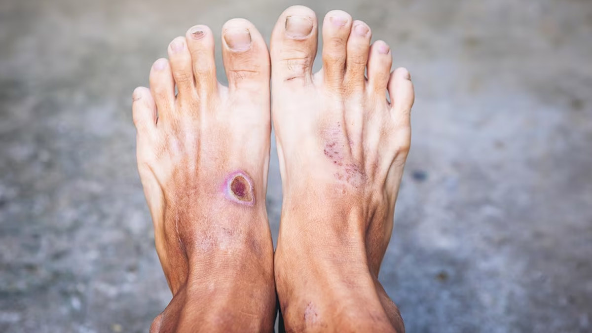 Prevent Diabetic Foot Ulcers and Avoid Amputation – Home Care Delivered
