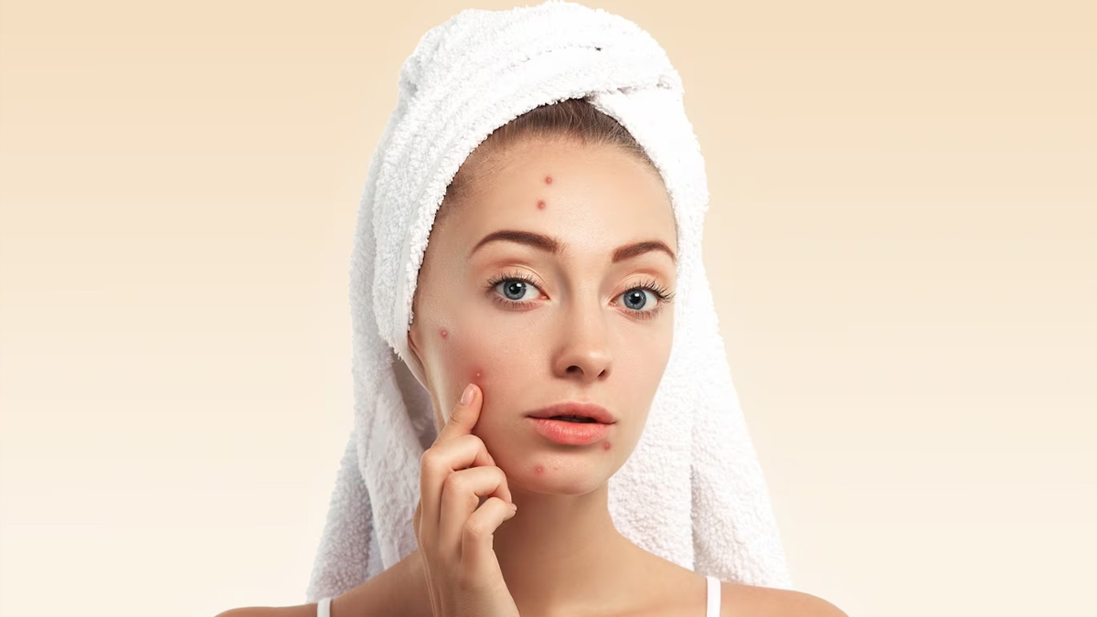 causes of acne