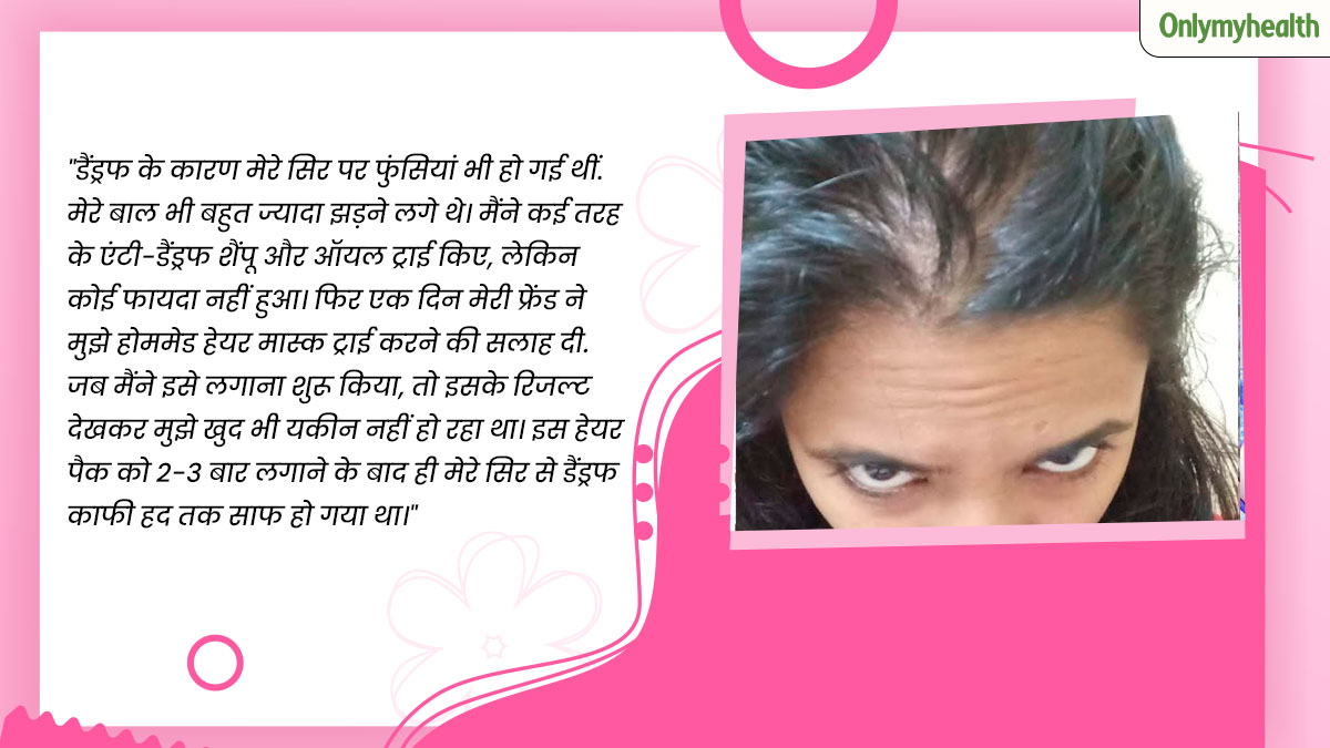 Dandruff-Hair-Mask-I