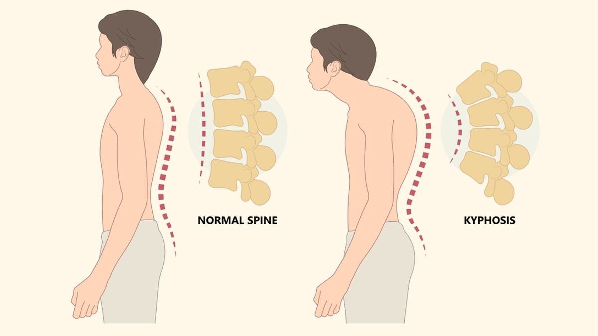 Exercises for a Healthy Spine - Dr Ishwara Keerthi C