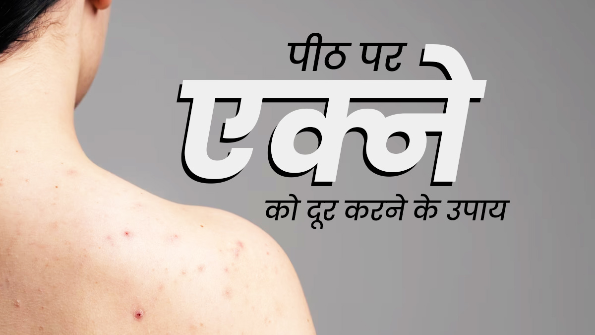 पसीने की वजह से पीठ पर हो गए हैं एक्ने, तो अपनाएं ये 5 घरेलू उपाय