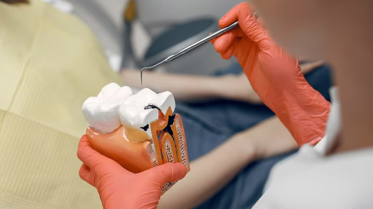 Dental Cavities: When Do You Need Root Canal Treatment For Cavities?
