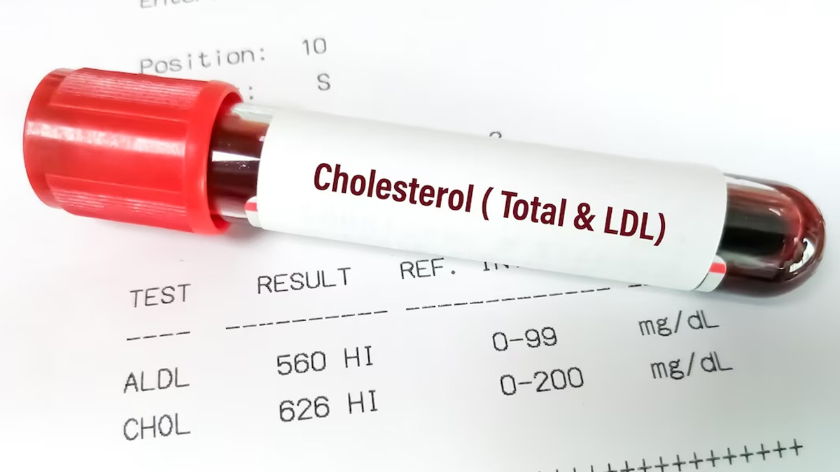 How Long To Fast Before Cholesterol Blood Test