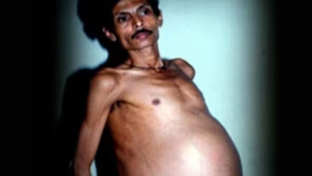 Medical Mystery: 36 सालों तक पेट में अपने जुड़वा भाइयों को लेकर घूमता रहा ये आदमी, डॉक्टरों ने समझा ट्यूमर