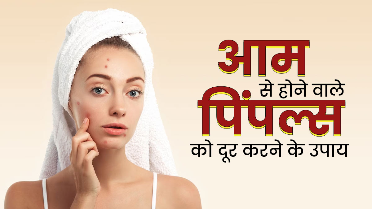 ज्यादा आम खाने से हो गये हैं मुंहासे, दूर करने के लिए अपनाएं ये 5 घरेलू उपाय 
