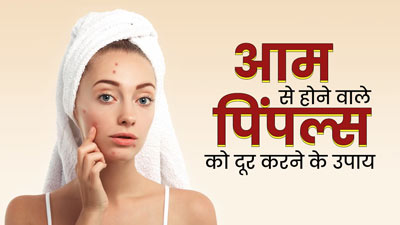 ज्यादा आम खाने से हो गये हैं मुंहासे, दूर करने के लिए अपनाएं ये 5 घरेलू उपाय 