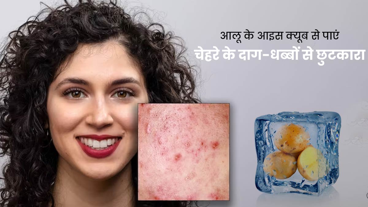 आलू के आइस क्यूब्स से पाएं चेहरे के दाग-धब्बों से छुटकारा, मिलेंगे अन्य फायदे भी