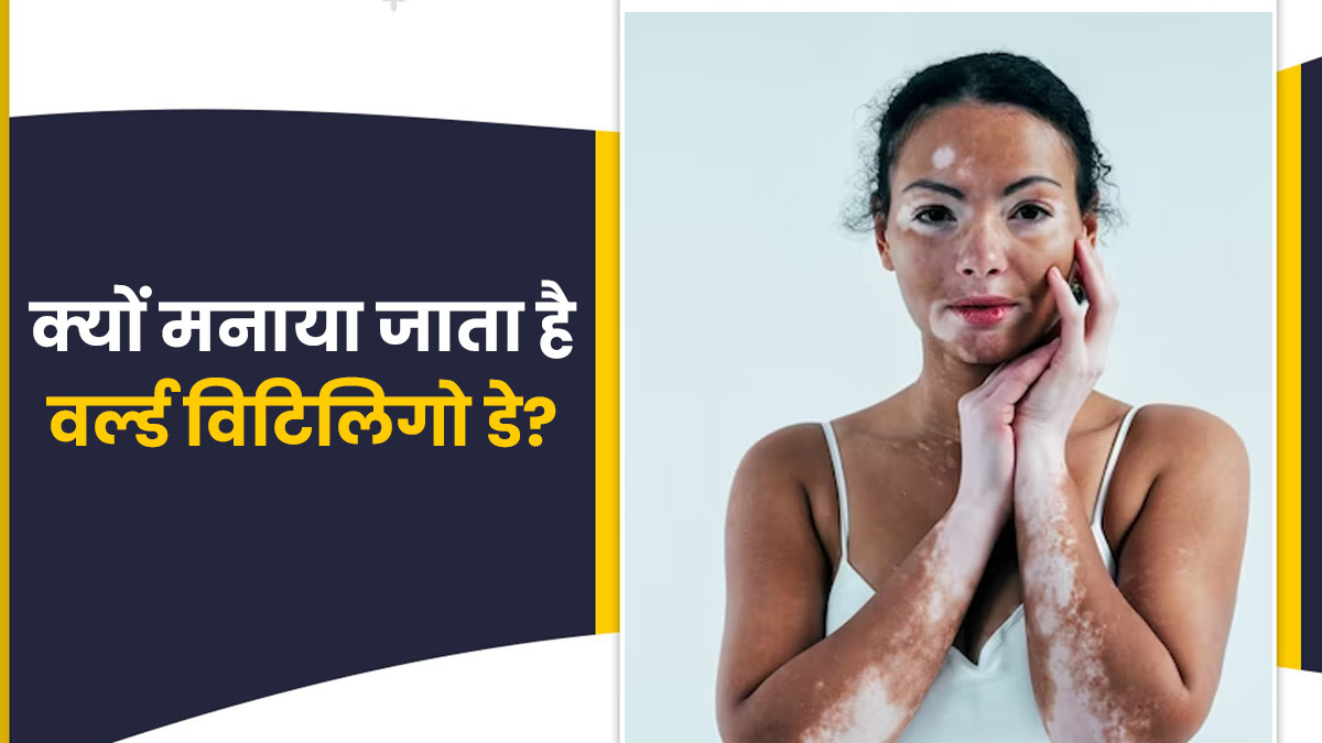 World Vitiligo Day 2023 विश्व विटिलिगो दिवस क्यों मनाया जाता है? जानें