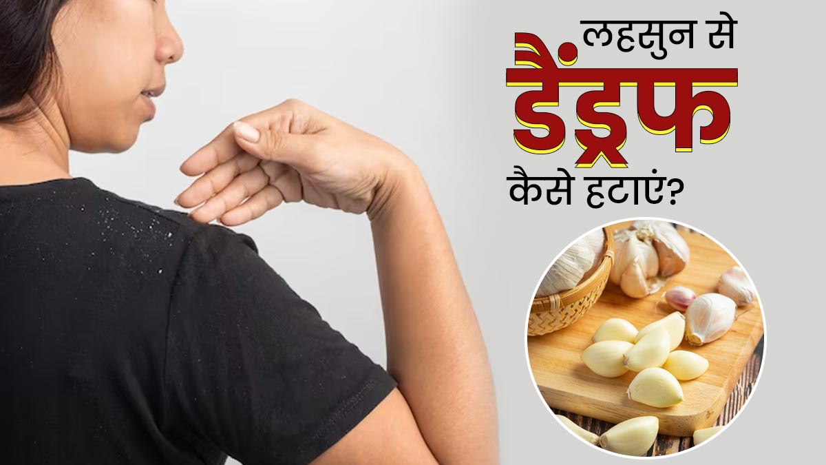 डैंड्रफ से छुटकारा पाने के लिए इन 4 तरीकों से करें लहसुन का इस्तेमाल, हेयर फॉल भी होगा कंट्रोल