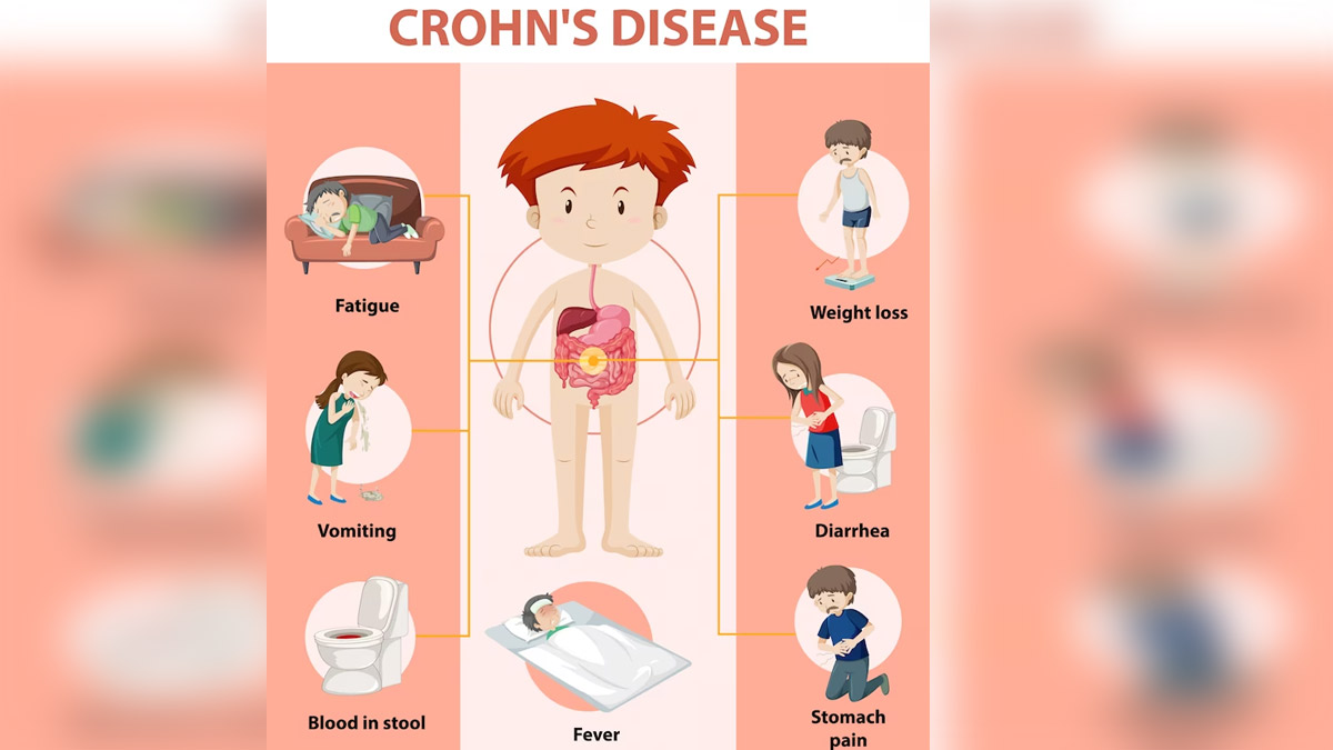 Crohn's Disease: Know About Its Complexity, Symptoms And Diagnosis