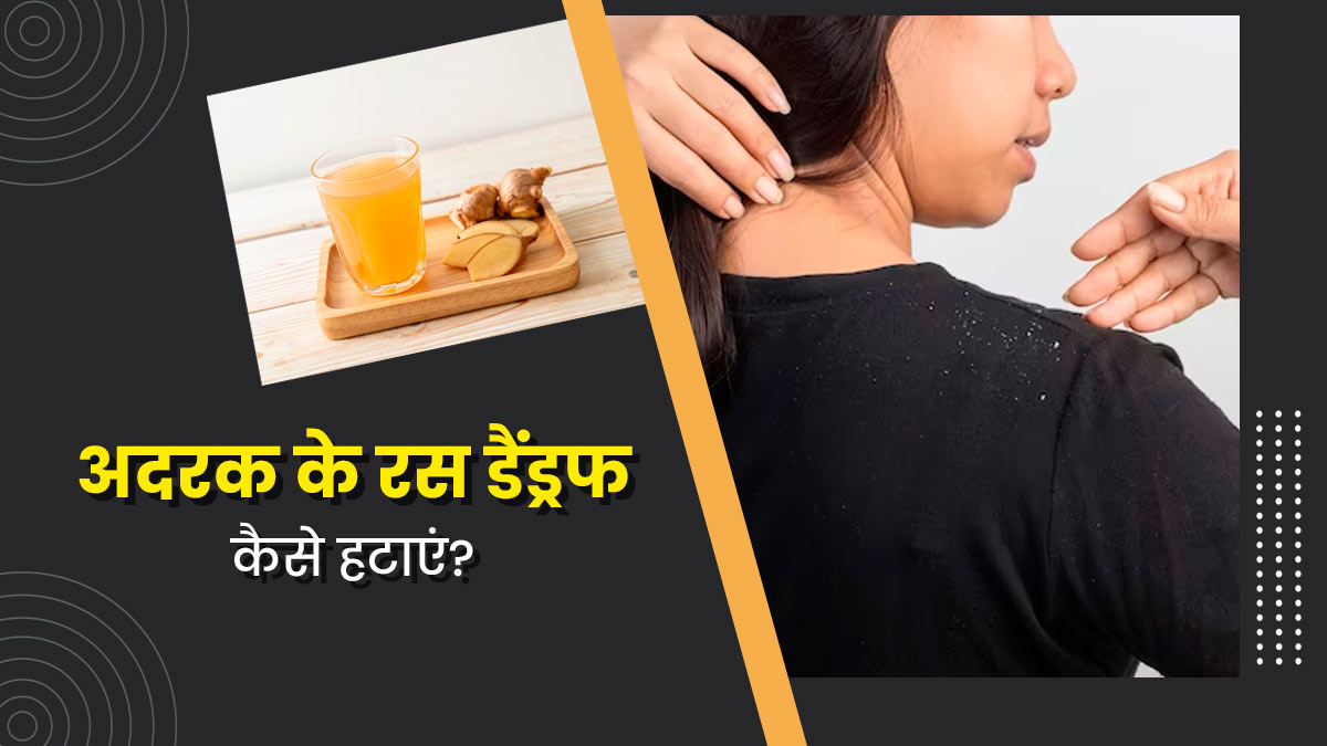 डैंड्रफ से छुटकारा पाने के लिए इस तरह करें अदरक के रस का प्रयोग, कई समस्याएं होंगी दूर