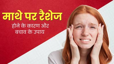 माथे पर रैशेज क्यों हो जाते हैं? जानें इसके कारण और बचाव के उपाय
