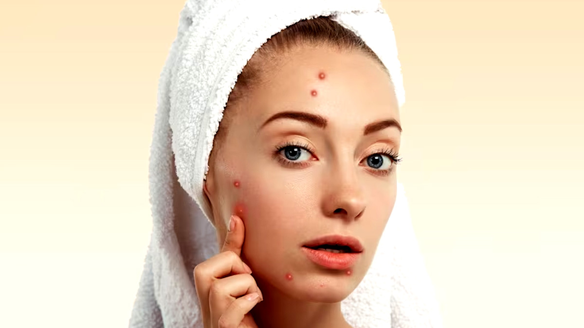 Sick Of Acne Breakouts? Ayurveda Expert Suggests Remedies To Manage It